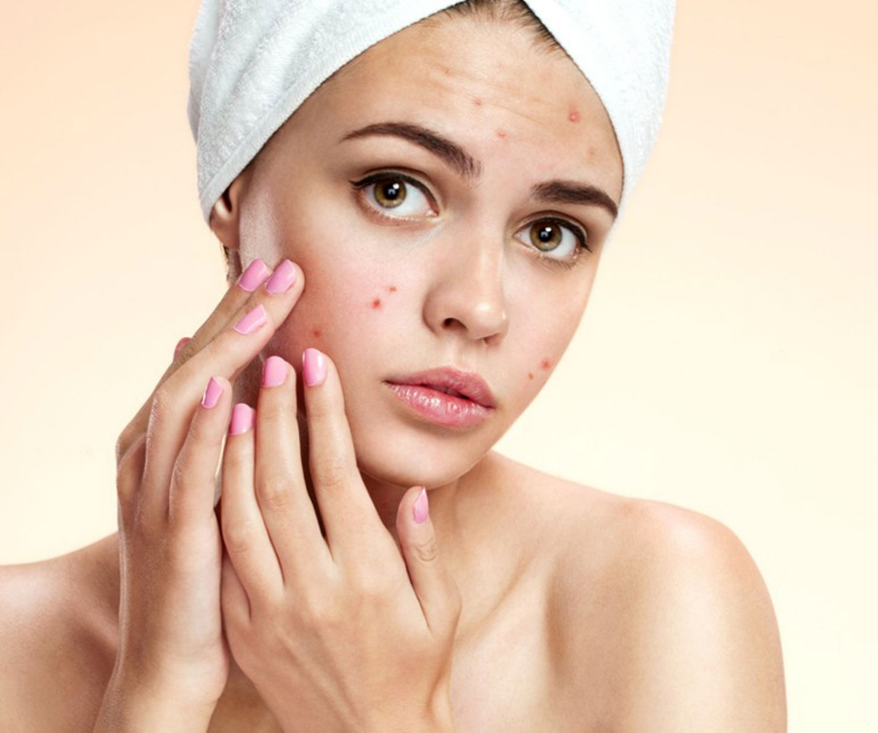 ACNE TRATMENT in Bilaspur Chhatishgarh